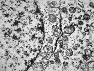 F,24y. | gangliocytoma